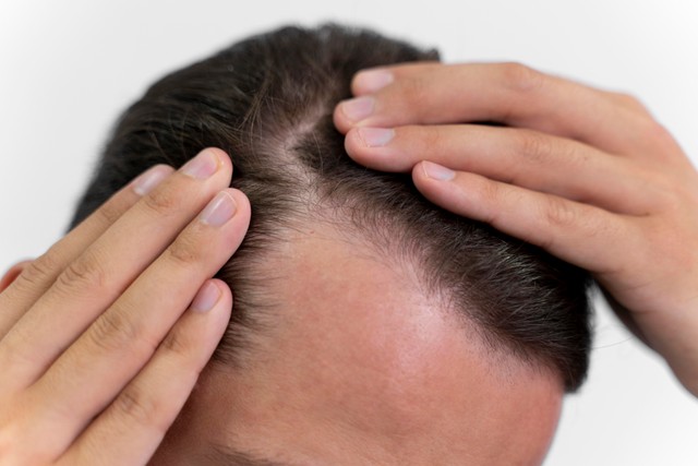 0. Causes and Diagnosis of Hair Loss